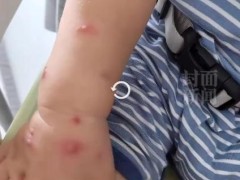 1岁男孩被女子强搂亲吻后发烧得水痘 水痘的潜伏期通常为10至21天！