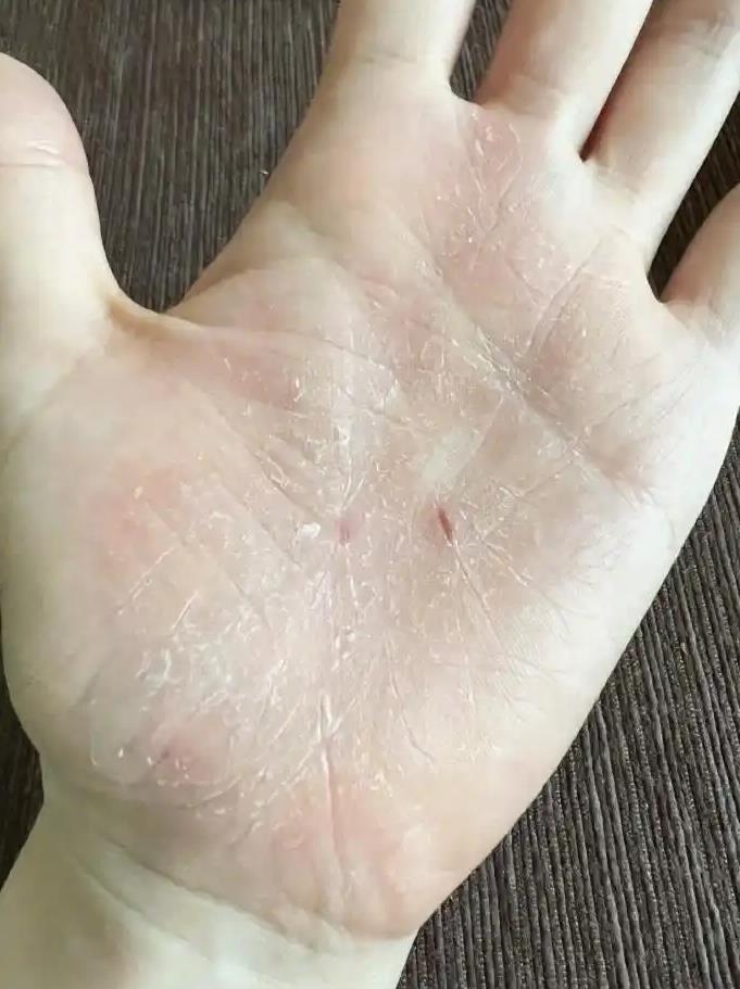 张靓颖自曝体检查出营养不良