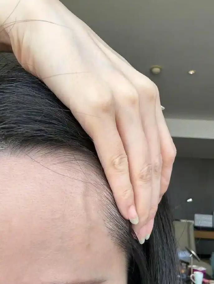 张靓颖自曝体检查出营养不良