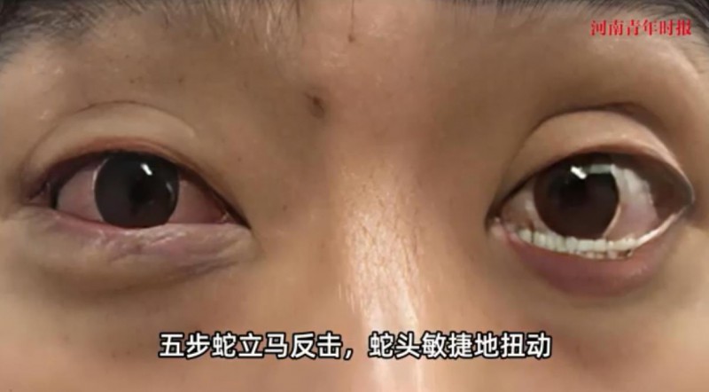 男子遇五步蛇想抓来玩 被喷一脸毒