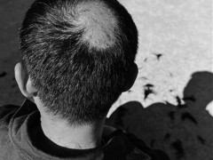 02年小伙长期熬夜成重度斑秃 报复性熬夜惹祸