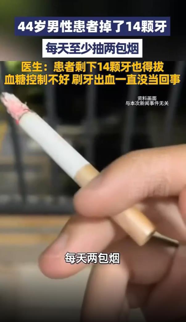 男子掉14颗牙 剩下14颗也得全拔掉 