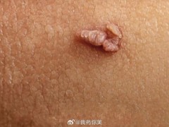 男子手上长肉芽剪掉又长疑感染HPV 拖延不治变花戒