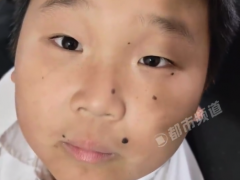 瞳孔地震具象化了!小男孩能控制瞳孔快速抖动
